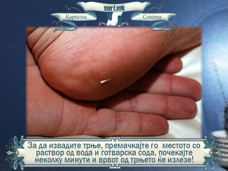 За да извадите трње, премачкајте го местото со раствор од вода и готварска сода, почекајте неколку минути и врвот од трњето ќе излезе!